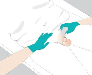 Apply the skin barrier before installing urinary catheter