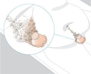 Trim hair follicles before installing male urinary cathether