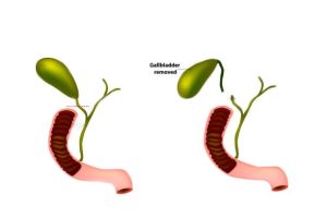 Cholecystectomy, the removal of the gall bladder