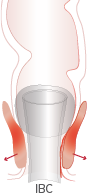 Don't over-inflate balloon cathers for stool management