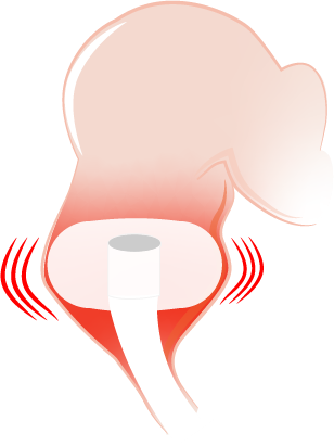 Why do balloon catheters leak? Over-inflating to reduce leakage may