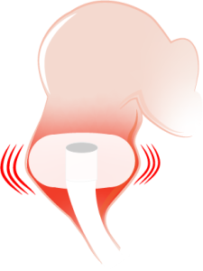 Over-inflated balloon catheter.