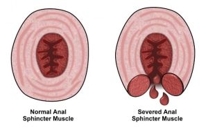 Severed vs normal sphincter muscles due to balloon catheter